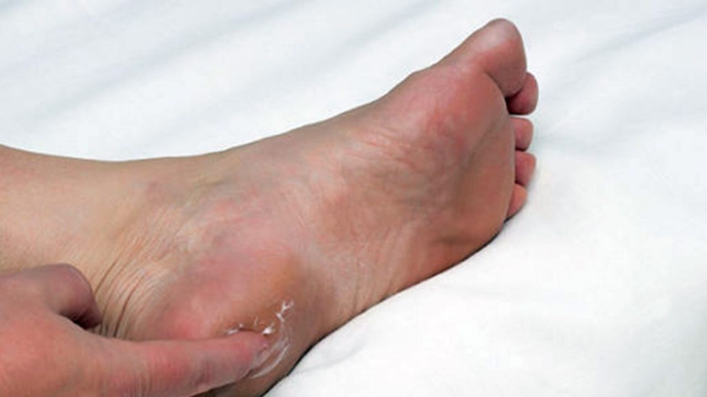 Uzmanlardan topuk dikeni uyarısı: ‘Çözüm dikeni kırmak değil’